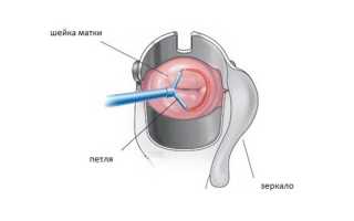 Электроэксцизия шейки матки: подробное описание процедуры