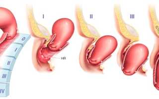 Можно ли забеременеть при опущении матки: особенности и опасность состояния