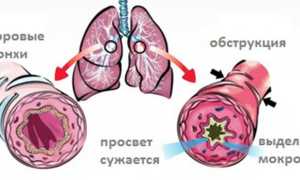 Острый обструктивный бронхит