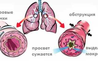 Острый обструктивный бронхит