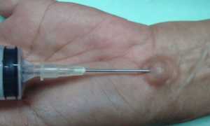 Гигрома запястья