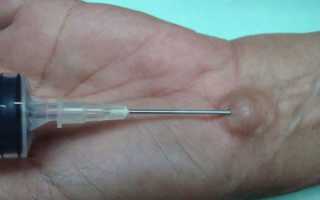 Гигрома запястья