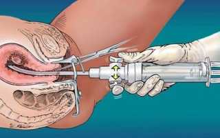 Какие выделения после выскабливания после замершей беременности являются нормальными?