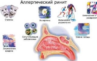 Лечение аллергического ринита у взрослых — эффективные препараты