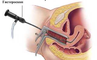 Лечение гиперплазии и миомы матки: медикаментозная терапия или операция?