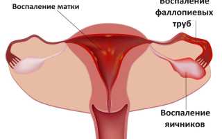 Подострый сальпингоофорит: причины, симптомы и лечение