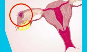 Гистерэктомия: можно ли забеременеть без матки