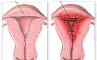 Что такое эндометрий переходного типа?