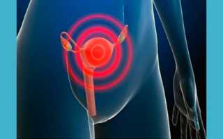 Забеременеть при миоме матки: можно или нет