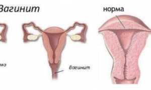 Эндометрит: лечение и симптомы у женщин