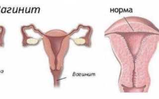Эндометрит: лечение и симптомы у женщин