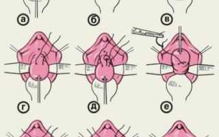 Серкляж шейки матки: основные техники проведения