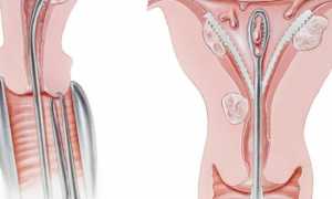 Пайпель-биопсия эндометрия: показания и подготовка