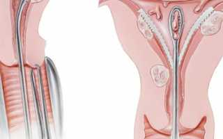 Пайпель-биопсия эндометрия: показания и подготовка