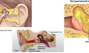 Отит без температуры у ребенка и взрослого