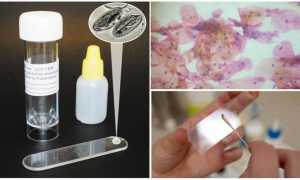 Соскоб на энтеробиоз: алгоритм взятия и результаты