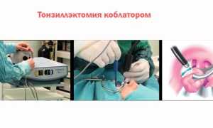 Удаление миндалин у взрослых и детей — показания и виды операций