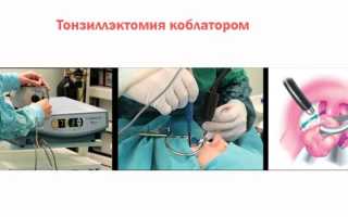 Удаление миндалин у взрослых и детей — показания и виды операций