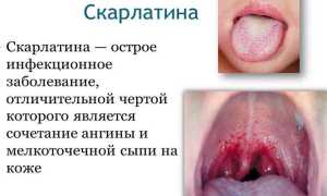 Профилактика скарлатины у детей — возбудитель заболевания и пути заражения, методы лечения