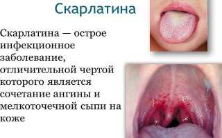 Профилактика скарлатины у детей — возбудитель заболевания и пути заражения, методы лечения