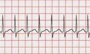 Диагностика и расшифровка аритмии: ЭКГ, тонометр, подсчёт пульса