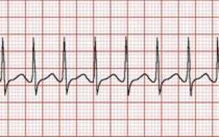Диагностика и расшифровка аритмии: ЭКГ, тонометр, подсчёт пульса