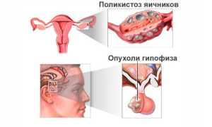 Причины аменореи у девушек — симптомы и виды патологии, диагностика, способы терапии