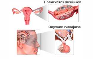 Причины аменореи у девушек — симптомы и виды патологии, диагностика, способы терапии