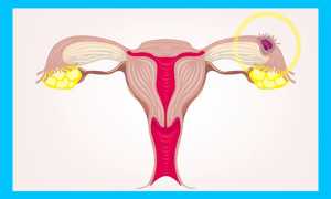 Внематочная беременность после ЭКО: причины, признаки, диагностика