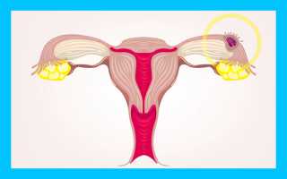 Внематочная беременность после ЭКО: причины, признаки, диагностика