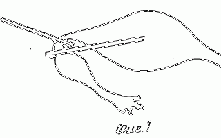 Процесс восстановления после внематочной беременности