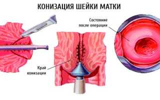 Как проводится ампутация шейки матки по Штурмдорфу?