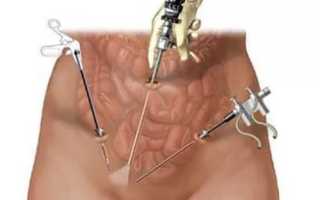 Как протекают месячные после удаления миомы матки?