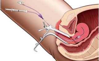 Как проводится промывание полости матки после родов?