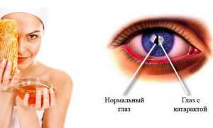 Лечение катаракты народными средствами в домашних условиях