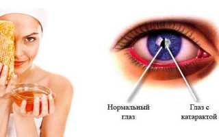 Лечение катаракты народными средствами в домашних условиях