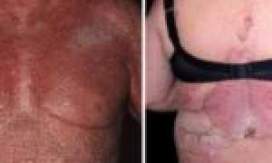 Последствия и опасности кожного заболевания псориаз