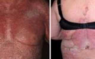 Последствия и опасности кожного заболевания псориаз