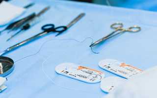 Операция при недержании мочи операции TVT  Санкт Петербург