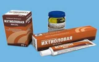 Можно ли применять ихтиоловую мазь при беременности для лечения геморроя?