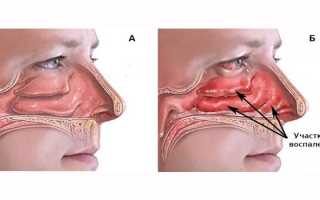 Хронический ринит — симптомы и лечение