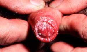 Чем можно лечить грибок половых органов?