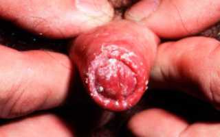 Чем можно лечить грибок половых органов?