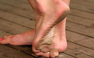 Подошвенные бородавки — причины возникновения, симптомы и лечение