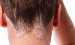 Грибок кожи головы у ребенка или взрослого — причины и признаки заболевания, диагностика, методы лечения