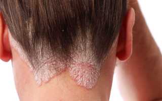 Грибок кожи головы у ребенка или взрослого — причины и признаки заболевания, диагностика, методы лечения