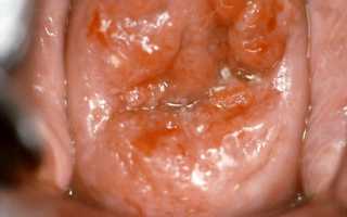 Как выглядит струп после прижигания эрозии, и как понять, что он отошел?