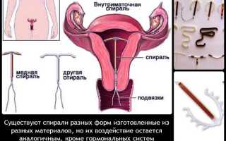 Может ли быть внематочная беременность со спиралью?