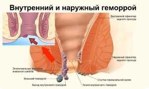 Геморрой при беременности — как лечить в домашних условиях
