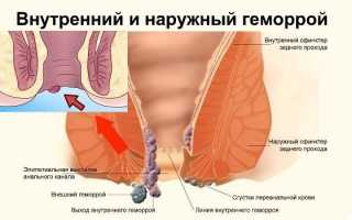 Геморрой при беременности — как лечить в домашних условиях